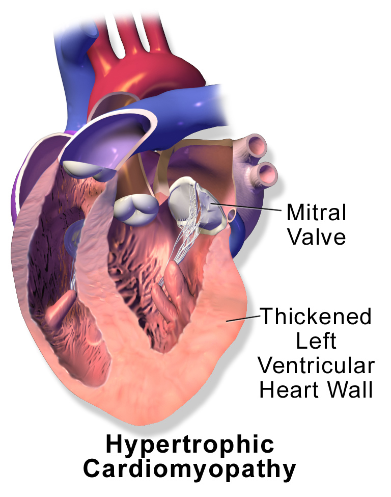 In the proteasome system dysfunction, damaged proteins build up in heart tissue over time. Reduced proteasome activity causes cardiomyopathy and eventually heart failure. ﻿Blausen Medical Communications