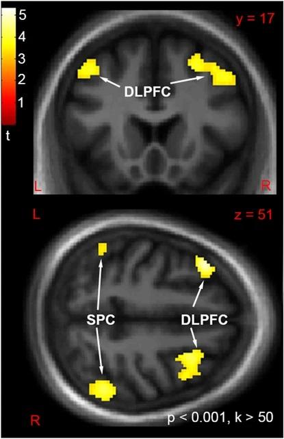People with schizophrenia have reduced activity in multiple brain areas, including the dorsolateral prefrontal cortex (DLPFC) and superior parietal cortex (SPC), shown here. These brain areas play important roles in cognitive functions such as attentional control, planning, and working memory. This image shows activation of the DLPFC and SPC, through a technique called functional magnetic resonance imaging (fMRI). (Jason Smucny, UC Davis)