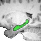 Brain scan depicting hippocampus 